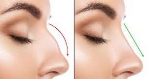 Droopy Nose Dilemma? Dubai's Rhinoplasty Solutions Unveiled!